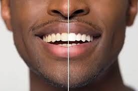 Teeth Whitening