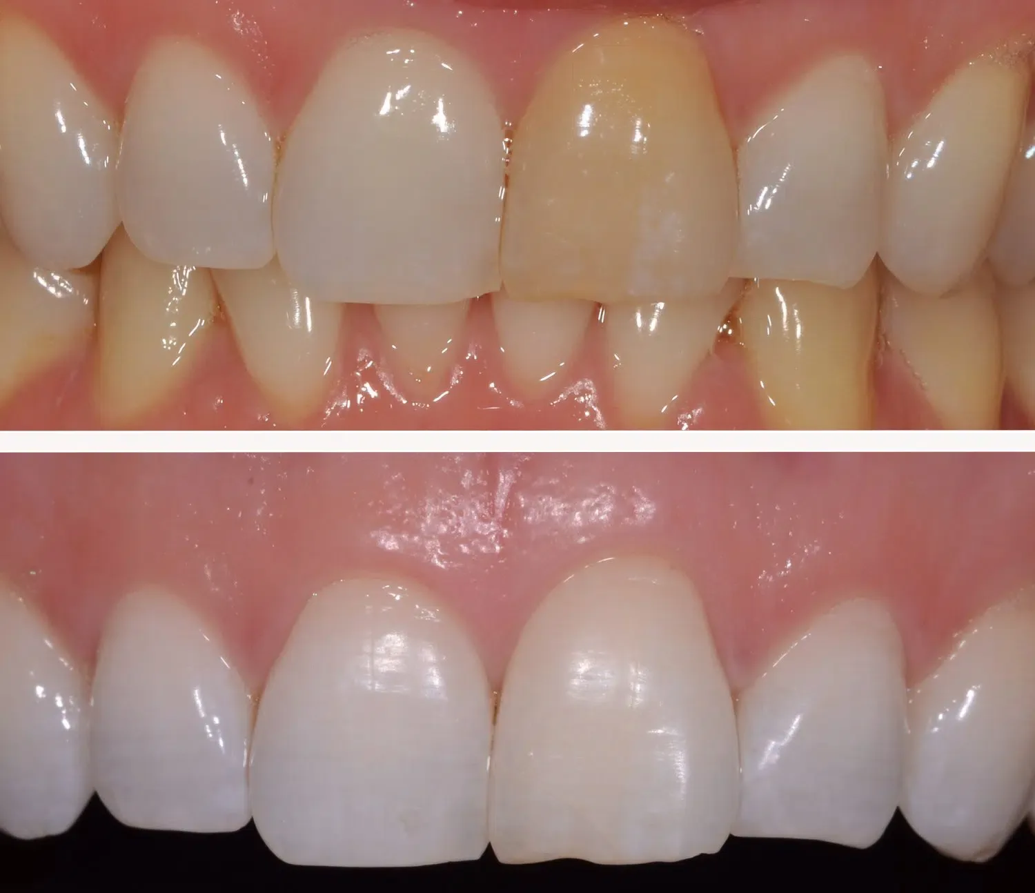 Root Canal Treatment