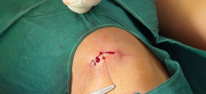 Minor Surgeries
